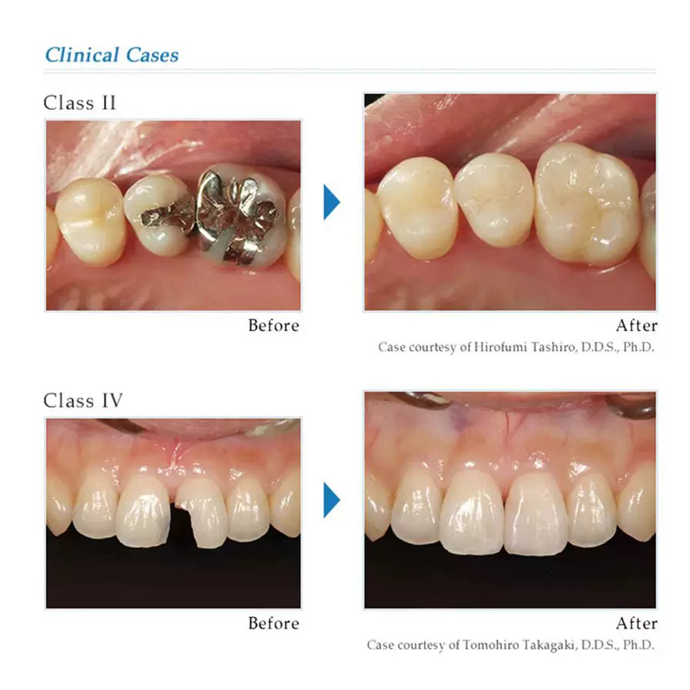 Tokuyama PALFIQUE LX5 Dental C - Lighting Jockey recensie en prijs